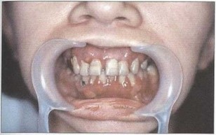 Рис. 1. Пациент А. (15 лет). ПОП (стадия абсцедирования). Выраженные явления воспаления в тканях пародонта. неудовлетворительная гигиена полости рта