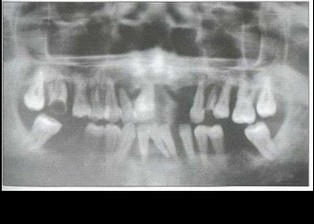 Рис. 2. Пациент Б. (16 лет). ГЮП (стадия ремиссии). Отсутствуют гиперемия и отек тканей пародонта, удовлетворительная гигиена полости рта, оголение на 7г длуны корней зубов
