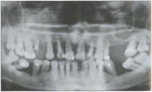 Рис. 2а. Ортопантомограмма пациента Б. Генерализованное поражение костной ткани альвеолярных отростков, убыль костной ткани составляет более 2/3 длины корней зубов, очаги деструкции имеют четкие границы