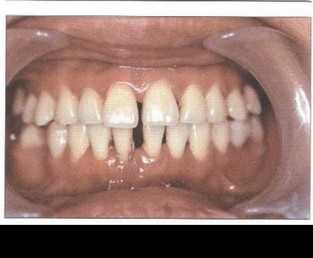 Рис. 5. Пациент Д. (25 лет). БПП (стадия ремиссии). Слизистая оболочка десневого края бледно-розового цвета, плотно прилегает к шейкам зубов. Гигиена полости рта удовлетворительная. Оголение более V2 длины корней зубов