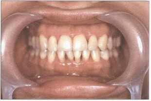 Рис. 6. Пациент Е. (30 лет). БПП (стадия ремиссии). Отсутствие признаков активного воспаления на фоне удовлетворительной гигиены полости рта