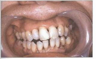 Рис. 17. Передняя дизокклюзия, протрузия 11, 12, 21, 22, тесное положение фронтальных зубов нижней челюсти
