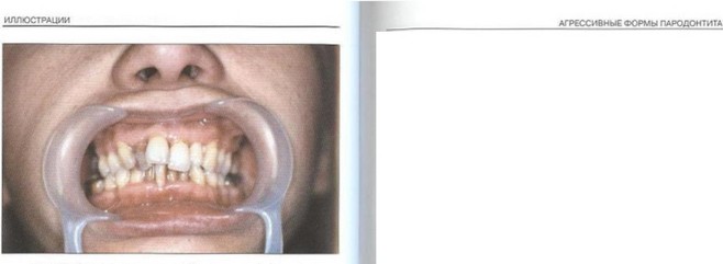 Рис. 23. Тесное положение зубов на нижней челюсти (III класс Энгля)