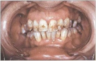 Рис. 27. Флюороз 1-11 степени, тесное положение зубов на верхней и нижней челюсях