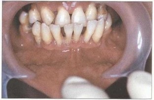 Рис. 32. Высокое прикрепление уздечки нижней губы, мелкое преддверие полости рта, прямая окклюзия, протрузия фронтальных зубов нижней челюсти, вторичная дизокклюзия зубов на нижней челюсти