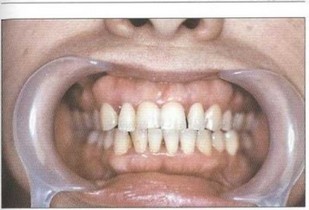 Рис. 37. Пациент Ж. (30 лет) с БПП. Удовлетворительная гигиена полости рта