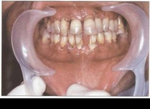 Рис. 37а. Пациент Ж. (30 лет) с БПП. Удовлетворительная гигиена полости рта, на ортопантомограмме — глубокие активные генерализованные деструктивные изменения