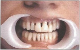 Рис. 42. Временное шинирование фронтальных зубов верхней и нижней челюстей с использованием “Fiber Splint” и жидкого фотополимера “Revolution”