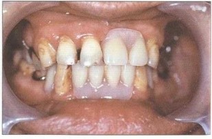 Рис. 43. Иммидиат-протезирование удаленных фронтальных зубов верхней и нижней челюстей