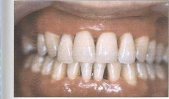 Рис. 48. Пациент Г. через 6 мес. после лечения. Слизистая оболочка бледно-розового цвета, из ПК отдельных зубов (24, 25) выделяется гной, зубы I-II степени подвижности. Кровоточивость при зондировании отсутствует. Глубина ПК 4,0-5,5 мм