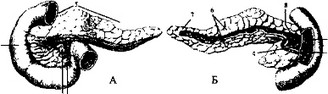 А - вид спереди: 1 - двенадцатиперстная кишка; 2 - головка поджелудочной железы; 3 - крючковидный отросток; 4 - верхняя брыжеечная вена и артерия; 5 - тело поджелудочной железы; б - дольки поджелудочной железы; 7 - хвост поджелудочной железы.