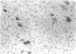 Рис.10. Мотонейроны переднего рога Ш поясничного сегмента спинного мозга. Потеря формы нейронов, хроматолиз, вакуолизация цитоплазмы, нейронофагия (стрелка). Окраска тионином.