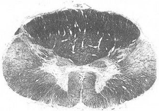 Рис. 21. Распад волокон боковых и передних канатиков. Уровень II грудного сегмента спинного мозга. Окраска шарлахом.