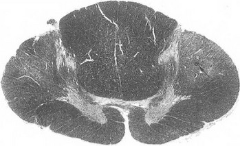 Рис. 36, VIII грудной сегмент спинного мозга. Периваскулярное скопление (стрелка) зернистых шаров в боковом канатике. Уменьшение объема боковых и передних канатиков. Окраска шарлахом. Микропланар 60.