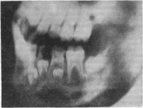 Рис. 2. Распространение актиномикозного процесса от зубов на костную ткань в детском возрасте (рентгенограмма).