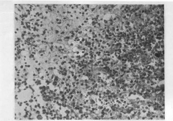 Рис. 5. Актиномикозная гранулема. Окраска гематоксилином и эозином. х200.
				а — скопления гигантских клеток типа инородных тел; б — скопления ксантомных клеток; в — скопления
				эпителиоидных клеток.