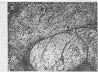 Рис. 9. Распространение полей склероза на мышечную гкань. Окраска гематоксилин-
				эозином. х 60.