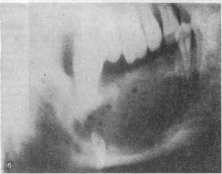 Рис. 13. Деструктивный актиномикоз челюсти справа, протекающий с гипоороги- ческой воспалительной реакцией
			
		а — внешний вид больной; б — рентгенограмма нижней челюсти справа.