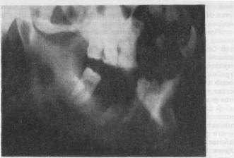 Рис 26. Вторичное поражение нижней челюсти справа актиномикозом внутрикост- ные абсцессы (рентгенограмма).