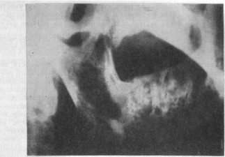 Рис. 28. Вторичное поражение тела и ветви нижней челюсти справа — продуктивнодеструктивное поражение (рентгенограмма).