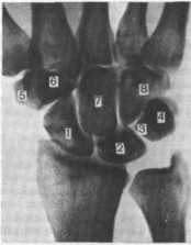 Рис. 2. Рентгенограмма кистевого сустава в прямой проекции. Центральный отдел сустава.