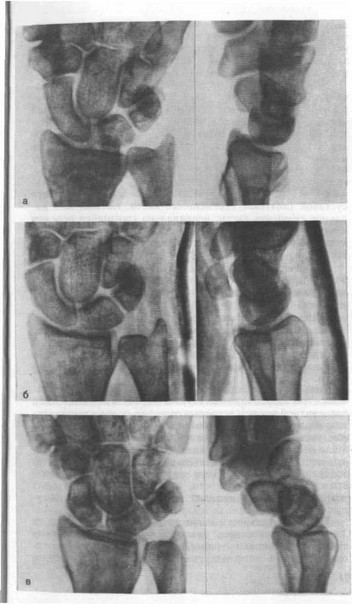 Рис. 7. Ладонная нестабильность кистевого сустава у больной 43 лет после сросшегося перелома лучевой кости в типичном месте.