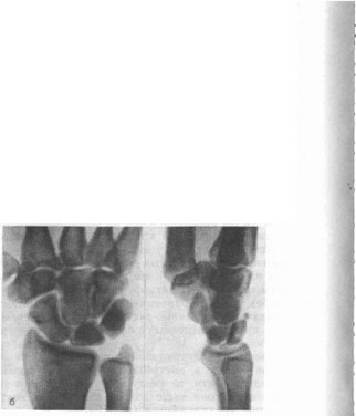Рис. 14. «Раздвоение» костей запястья (рентгенограммы)