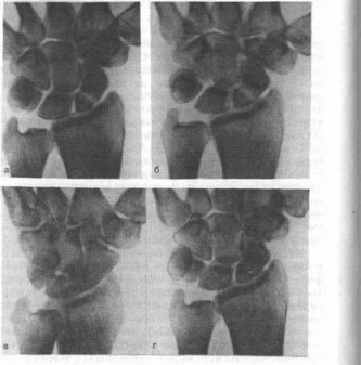 Рис. 27. Рентгенограммы больного 32 лет с несросшимся поперечным переломом ладьевидной кости в проксимальной трети, впервые распознанным через 9 мес