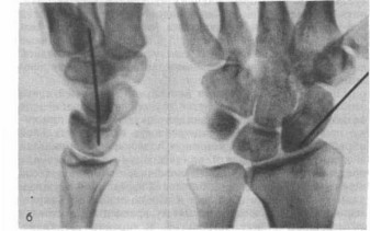 Рис. 28. Рентгенограммы больного 21 года, оперированного по поводу несросшегося нестабильного перелома ладьевидной кости с выраженным рассасыванием на концах фрагментов