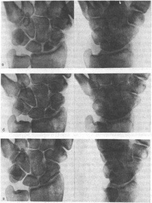 Рис. 30. Рентгенограммы больного 35 лет, оперированного по поводу ложного сустава в проксимальной трети ладьевидной кости с аваску- лярными изменениями в проксимальном фрагменте