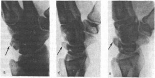 Рис. 32. Перелом бугорка трехгранной кости (указан стрелками) у женщины 45 лет, расцененный как «отрывной перелом ладьевидной кости».