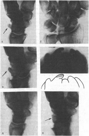 Рис. 33. Рентгенограммы больного 49 лет, оперированного по поводу остеофита трехгранной кости (указан стрелкой), появившегося после травматичного удаления полулунной кости при болезни Кинбека и обнаруженного при обследовании в связи с развитием синдрома захлестывания (рентгенограммы)