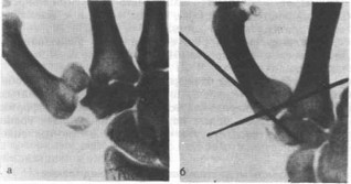 Рис. 37. Вертикальный перелом трапеции, сочетающийся с переломо- вывихом Беннета, у мужчины 21 года в результате удара кулаком (рентгенограммы)