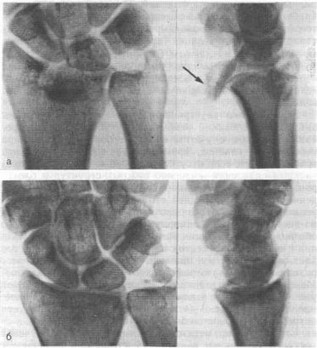 Рис. 40. Оскольчатый перелом дистального конца лучевой кости с вывихом фрагмента эпифизарной пластинки у больного 26 лет (рентгенограммы).