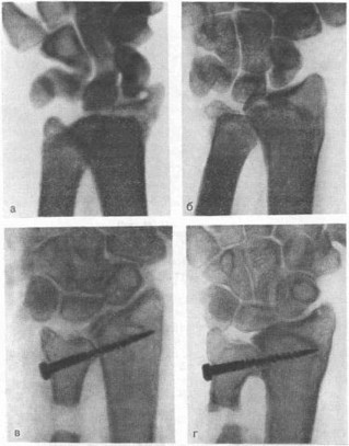 Рис. 41. Рентгенограммы больной 22 лет, оперированной по поводу застарелой посттравматической деформации кистевого сустава