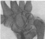 Рис. 43. Ложный сустав дистального метаэпифиза лучевой кости с лучевой косорукостью у больной 50 лет после автоаварии (рентгенограммы) .