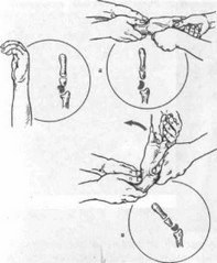 Рис. 49*. Закрытое ручное вправление вывиха полулунной кости дистрак- ционно-рычаговым способом (слева вывих полулунной кости III степени).