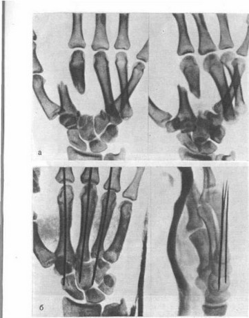 Свежий дивергирующий вывих пястных костей у больного 23 лет после придавливания тыла кисти тяжестью (рентгенограммы