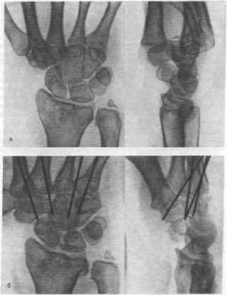 Застарелый вывих «локтевых» пястных костей давностью 7 мес у больной 21 года после падения с высоты и множественных повреждений (рентгенограммы)