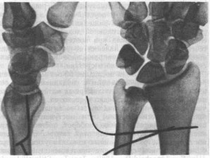 Свежий ладонный вывих головки локтевой кости трехдневной давности у больного 55 лет в результате форсированной супинации предплечья при фиксированной кисти
