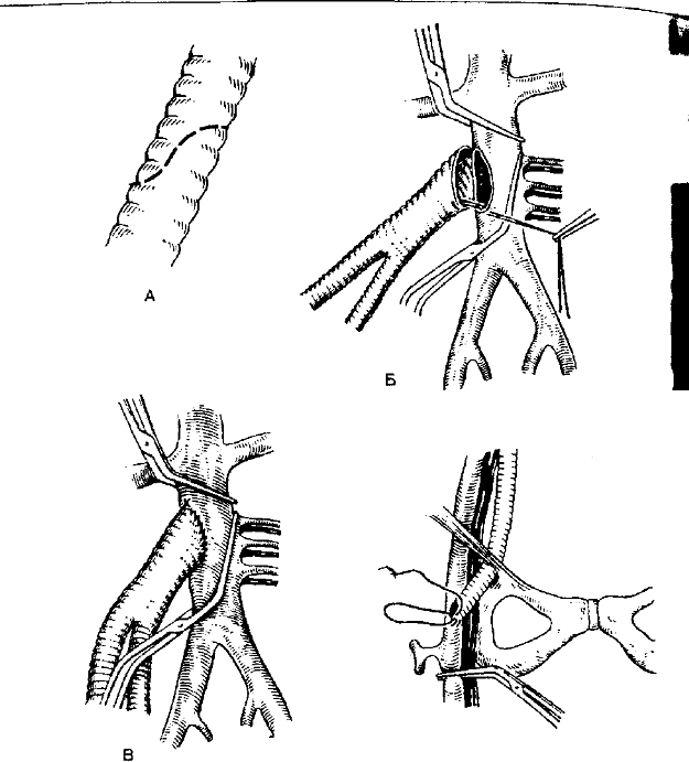 Рис. 8~4. Схема аортобедренного шунтирования.