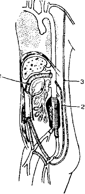 Рис. 8—11. Методы шунтирования вне зоны гнойного очага при инфицировании аорто подвздошного протеза.