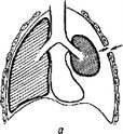 Рис. 8. Схема открытого (а) и закрытого (б) пневмоторакса.