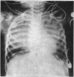 Рис. 26. Обзорная рентгенограмма грудной клетки ребенка во время интенсивной терапии вслед за реанимацией после анафилаксии на введение меперидина.