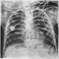 Рис. 27. Обзорная рентгенограмма грудной клетки спустя 24 ч после проявления анафилаксии.