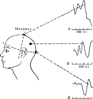 Рис. 4.3. Типичные вызванные потенциалы на слуховое (Л), соматосенсорное (Б) и зрительное (В) раздражения. Прерывистыми линиями указаны области кожи головы, от которых регистрируются наиболее выраженные пики (Bioelectric Recording Techniques. Part В. Eds. Thompson R. F., Patterson М., 1973.)