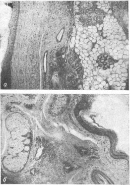 Микрофотограмма стенки дермоидной кисты