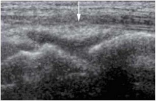 Рис. 2.2. УЗИ правого лучезапястного сустава (продольное сканирование)