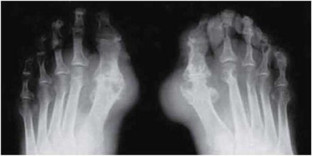 Рис. 8.1. Рентгенологическая картина подагрического артрита стоп ног