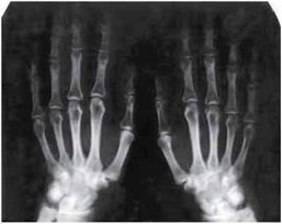 Рис. 9.1. Рентгенограмма кистей. Определяется сужение рентгенологических суставных щелей.